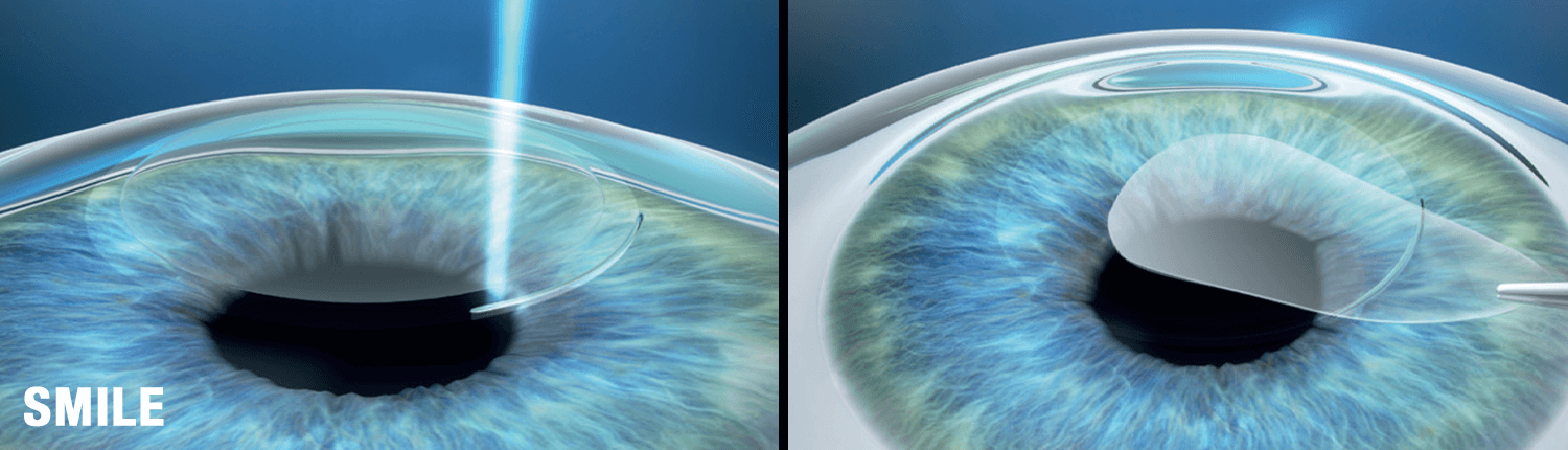 Illustration of SMILE Eye Surgery