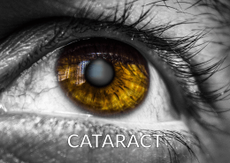 image of cataract in brown eye
