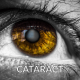 image of cataract in brown eye