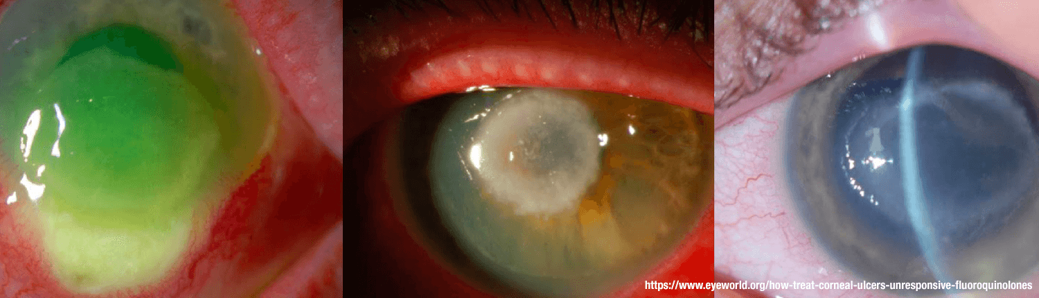 Images showing Corneal Ulcers