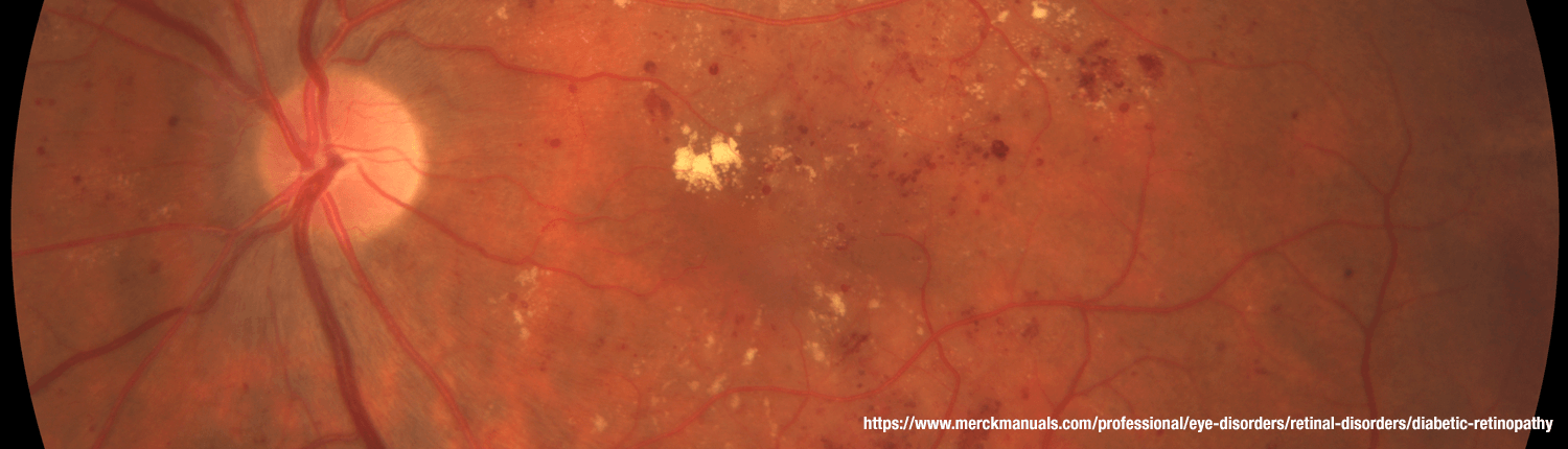 Image of Diabetic Retinopathy