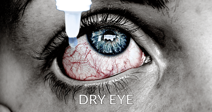 dry eye