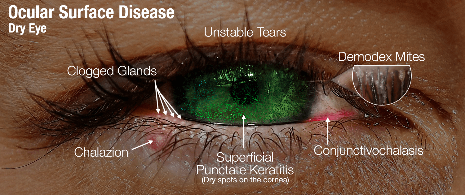 Image of Eye illustrating ocular surface disease and meibomian gland dysfunction