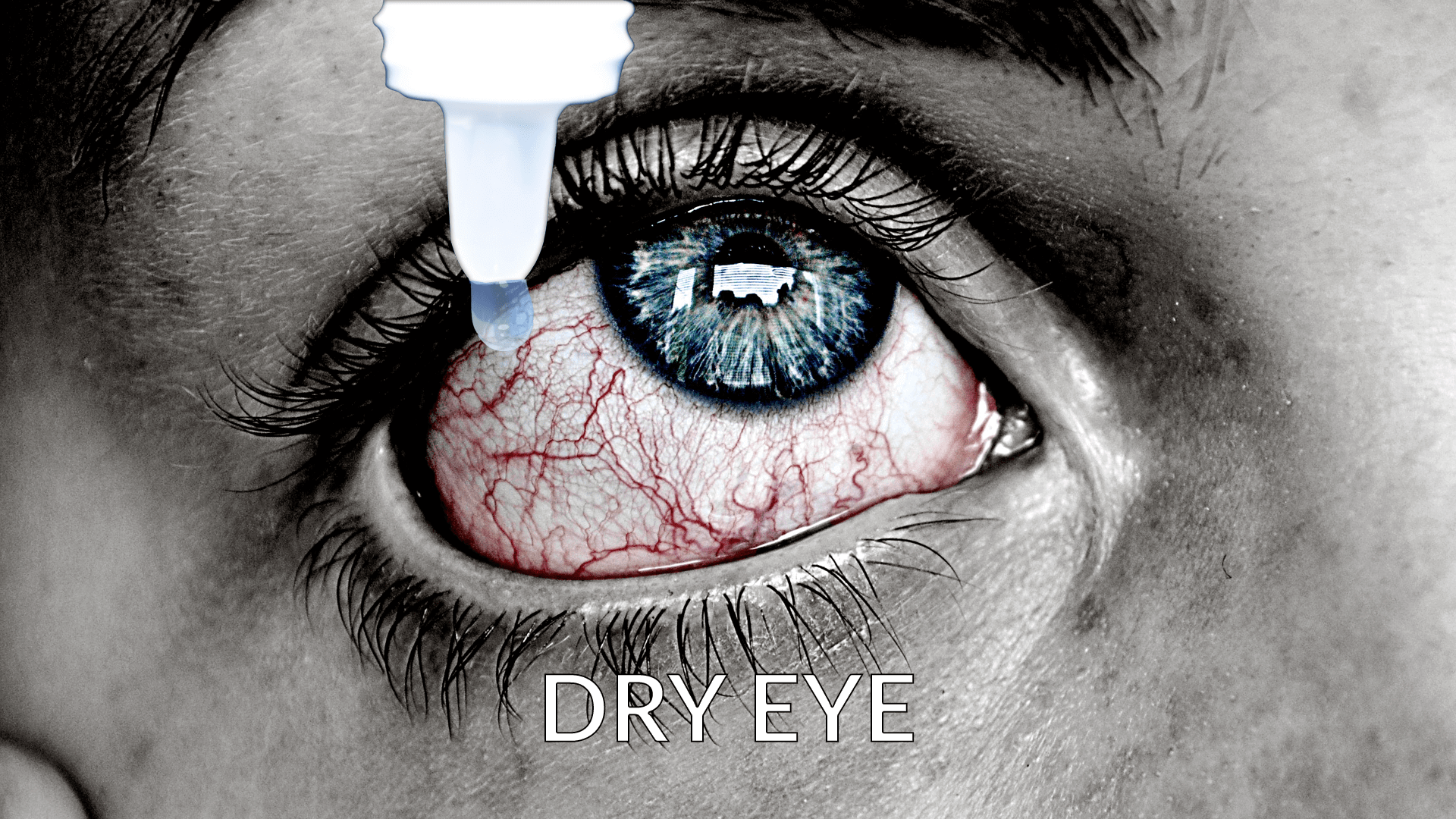 dry eye