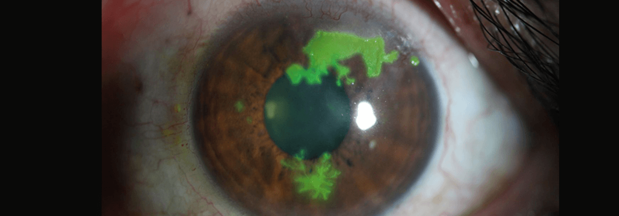 Illustration of Herpes Simplex Virus on an eye