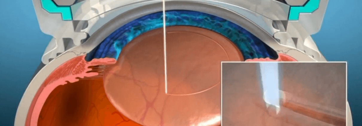 Image showing how a lasik flap is created with a laser