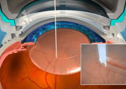 Image showing how a lasik flap is created with a laser