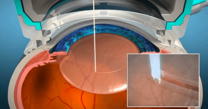 Image showing how a lasik flap is created with a laser