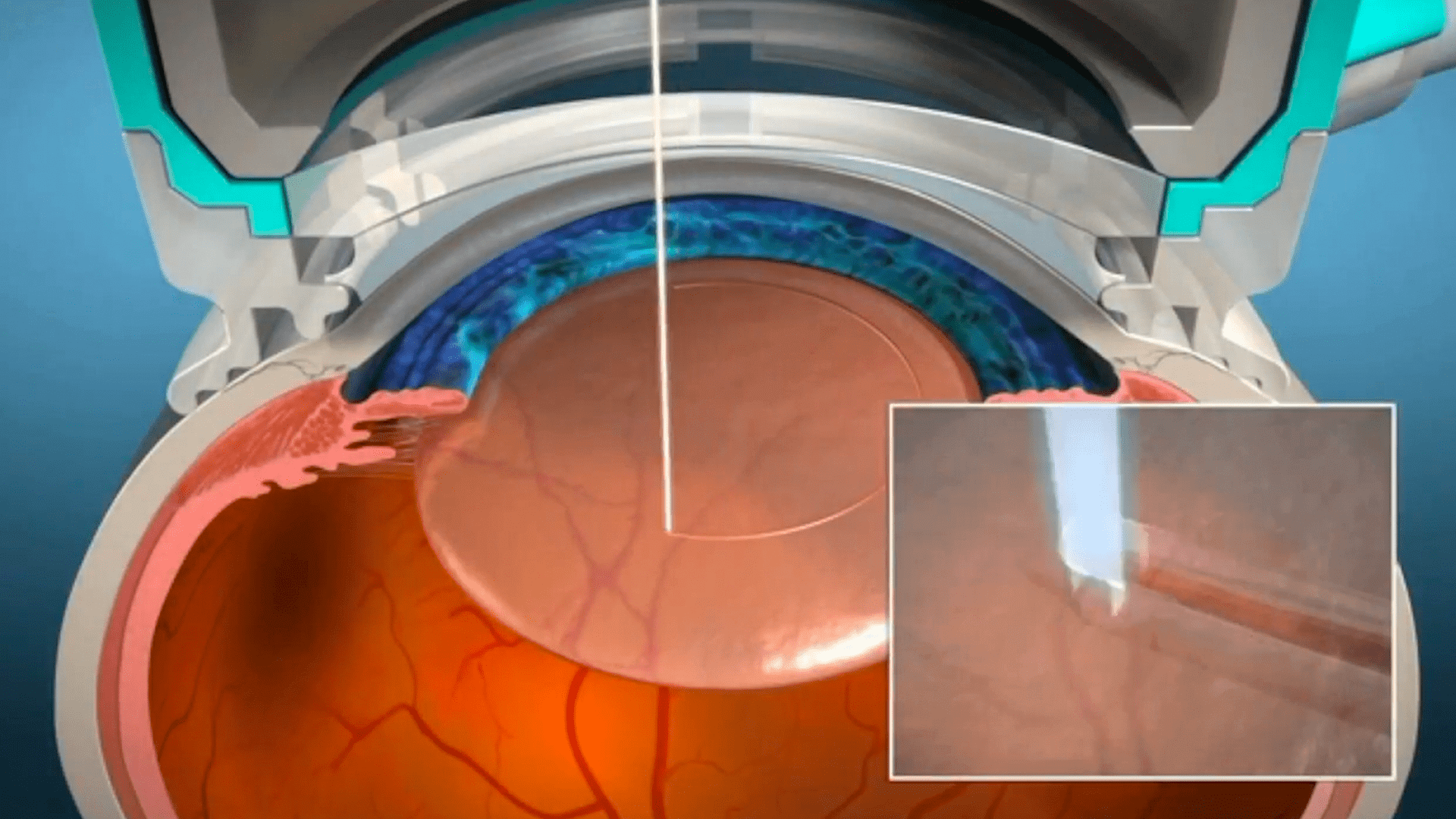 6 Common Vision Problems and How to Fix Them Texas Eye Surgeons
