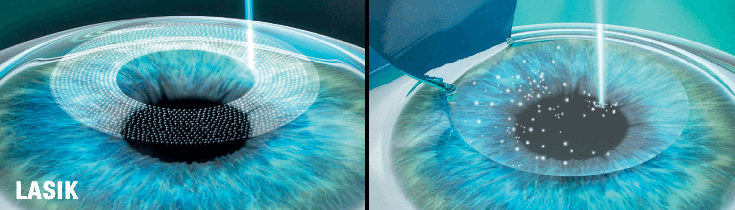 Illustration how a LASIK Flap is made with a laser