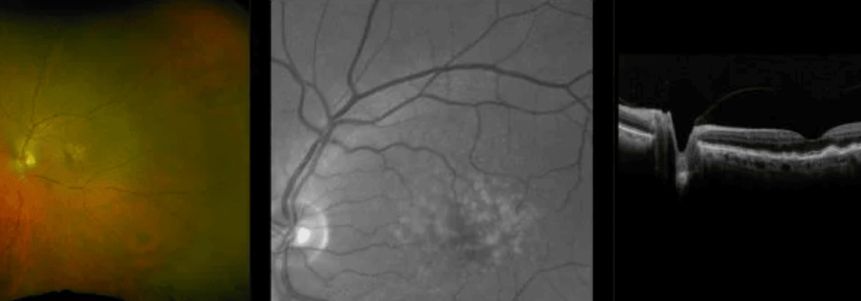 Illustration defining Macular Degeneration