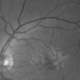 Illustration defining Macular Degeneration