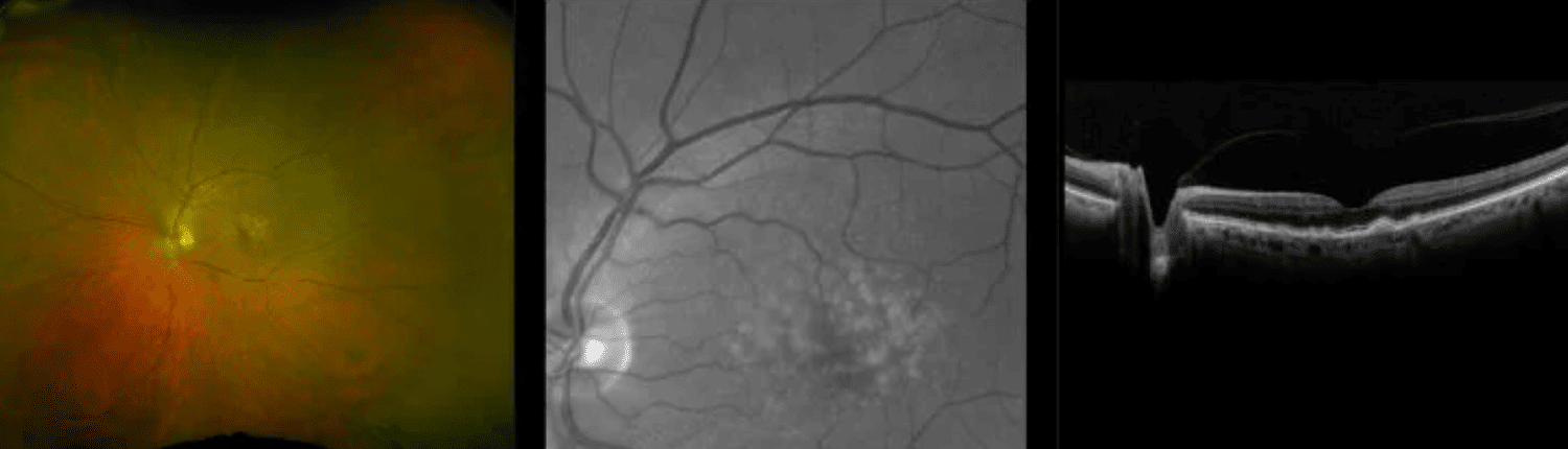 Illustration defining Macular Degeneration