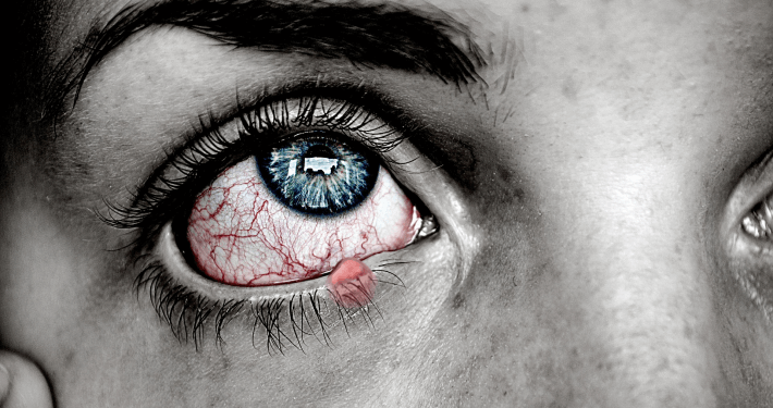 Stye Illustration