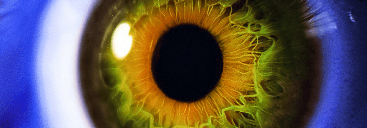 Image of a clear eye after Yag following Cataract surgery